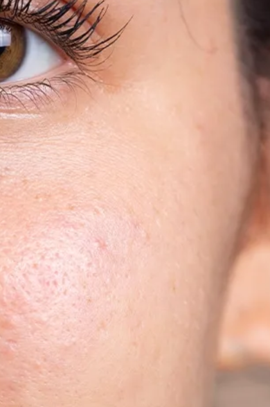 Rosacea