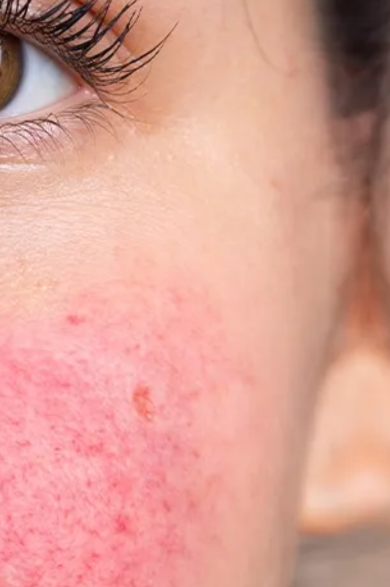 Rosacea